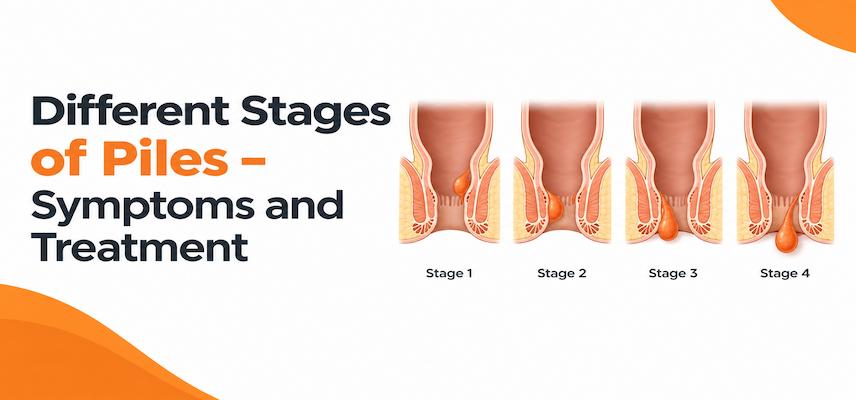 Different Stages of Piles- Symptoms and Treatment
